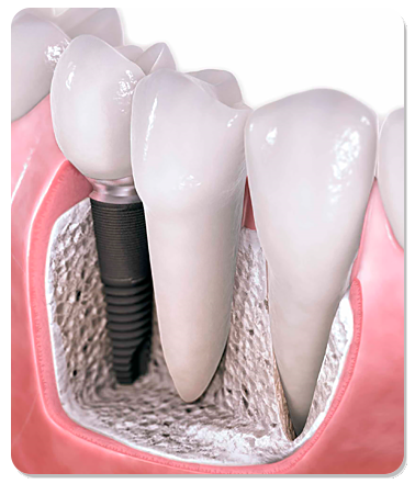 Dental Implants  Bradenton Florida